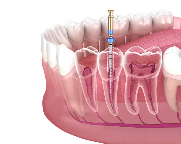 Root Canal Treatment