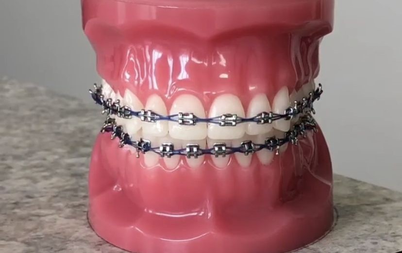 braces