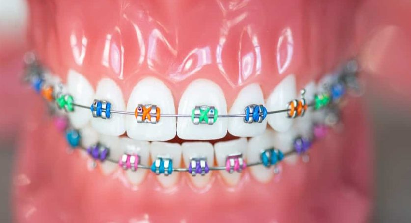 Braces colors