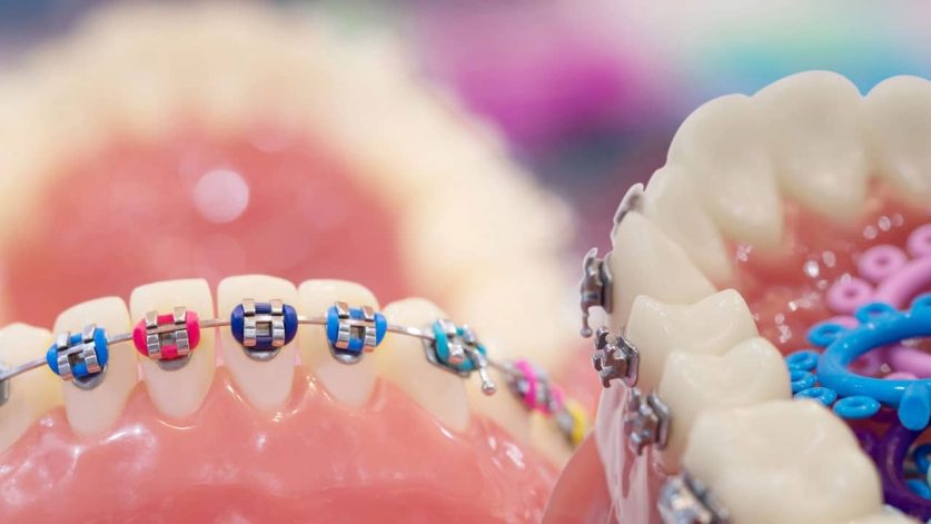 Braces Color