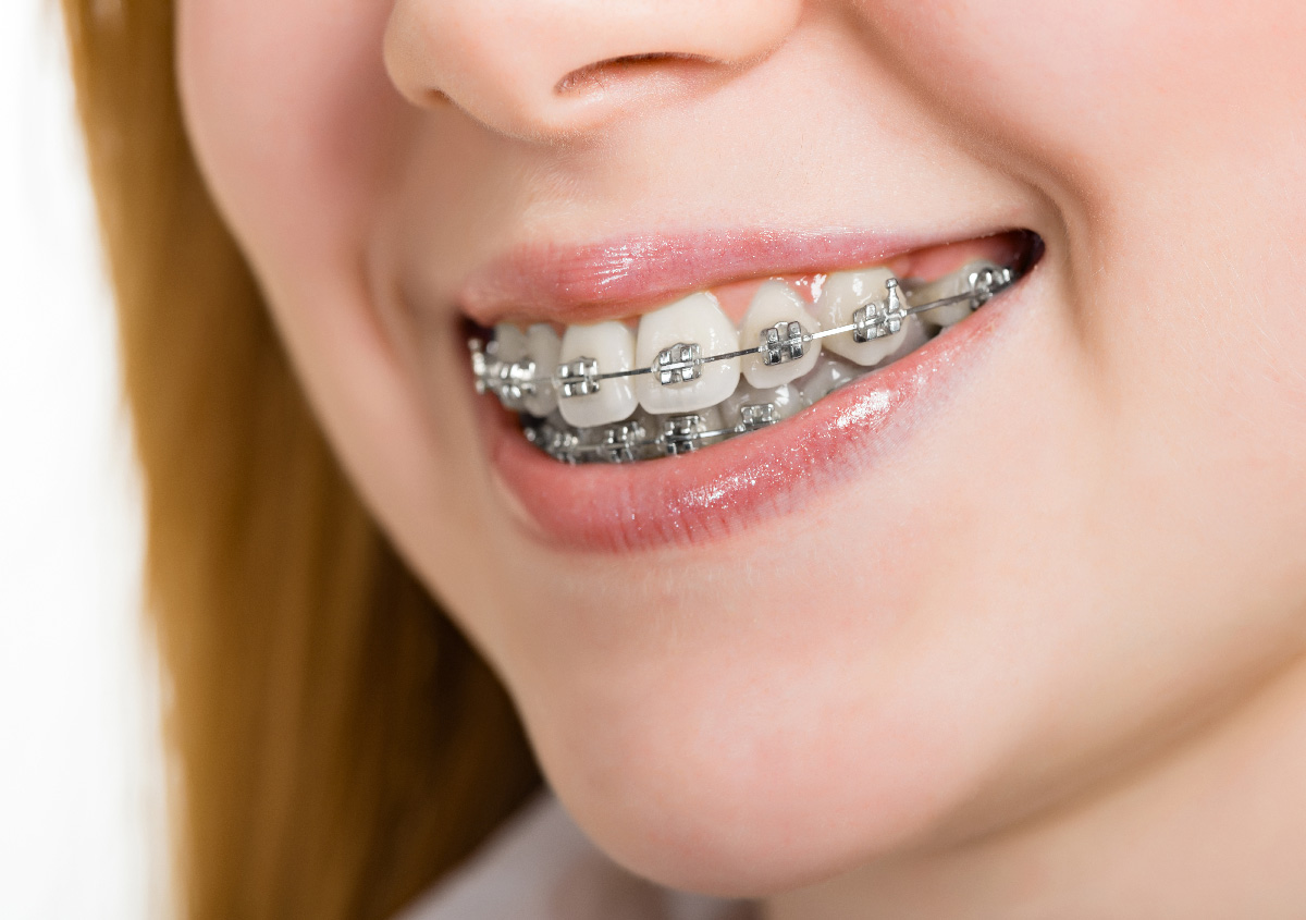 best braces colors to get