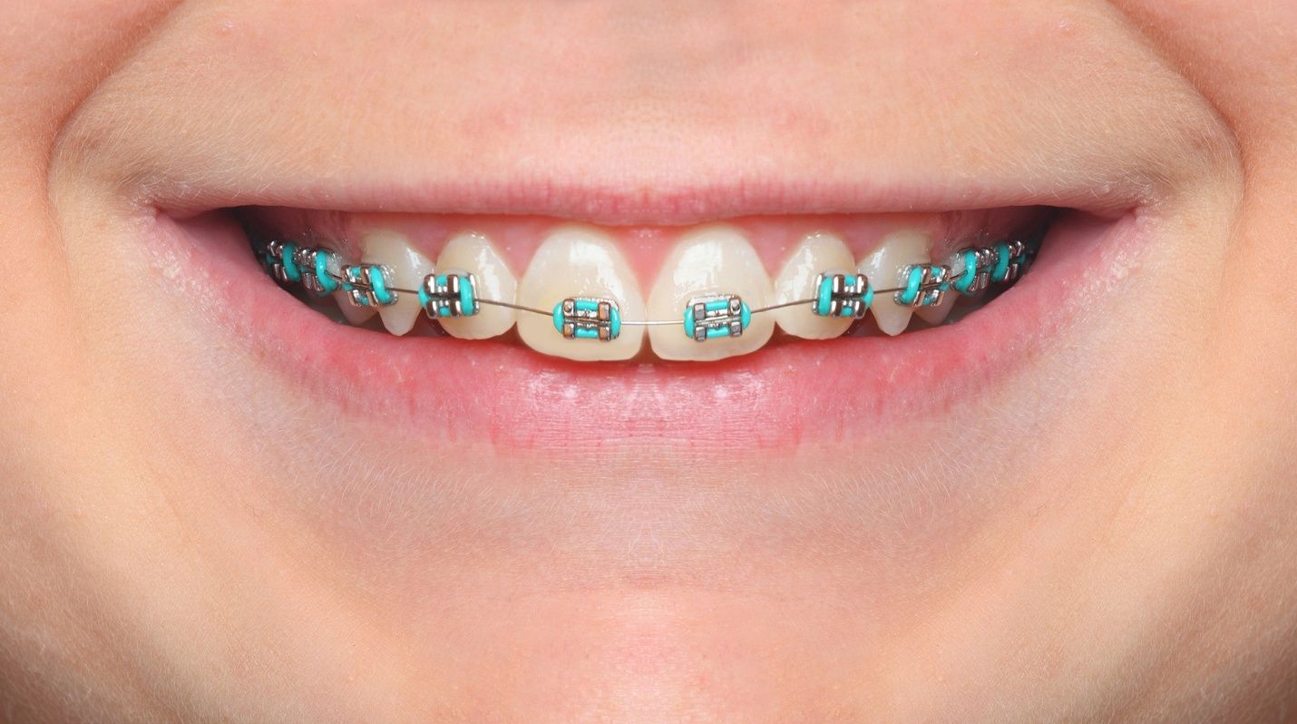 miami beach orthodontics.