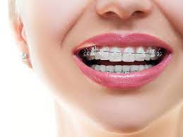 best braces colors to get