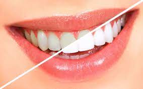 Teeth whitening near me