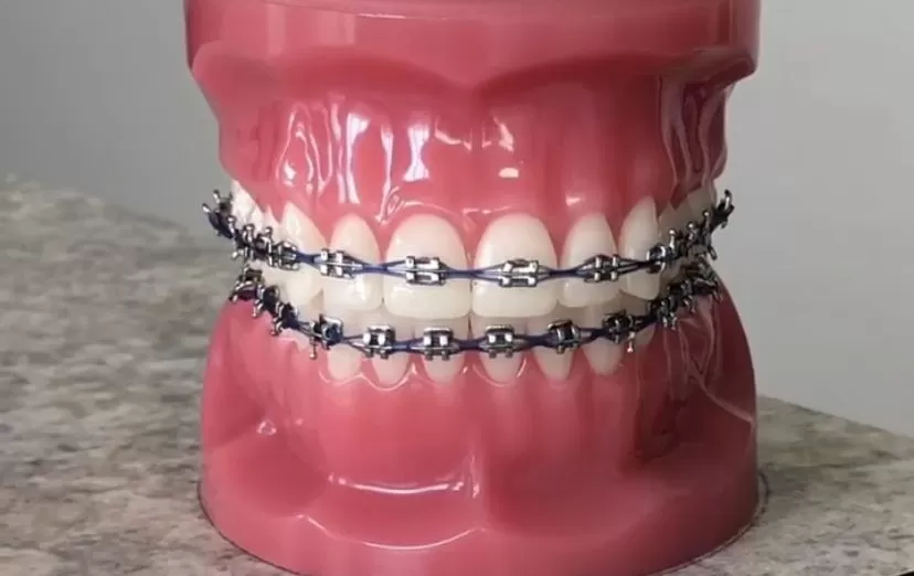 braces