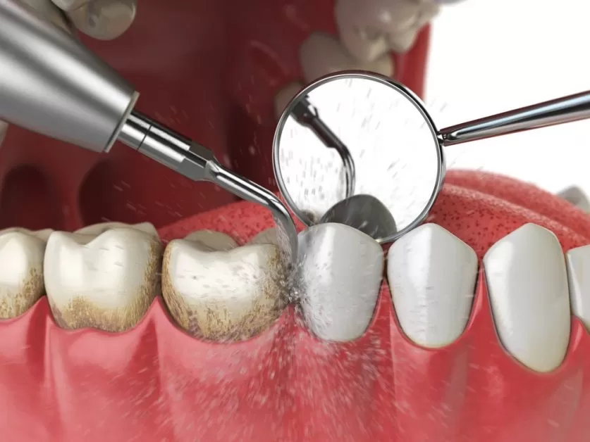 Deep Teeth Cleaning