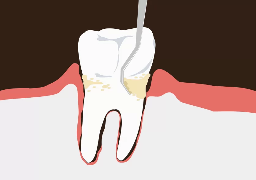 dental deep cleaning